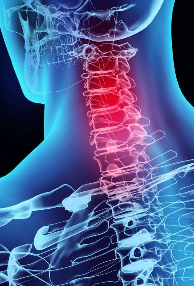 Whiplash is a type of neck injury.